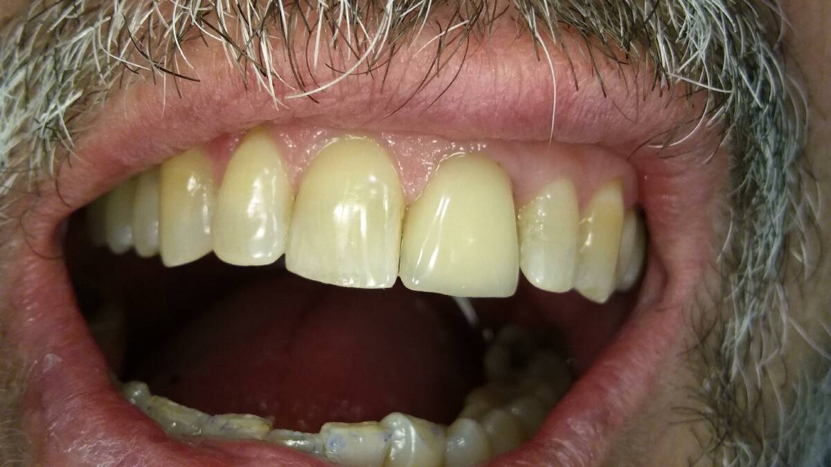 AFTER: Dental implants look just like your own teeth.