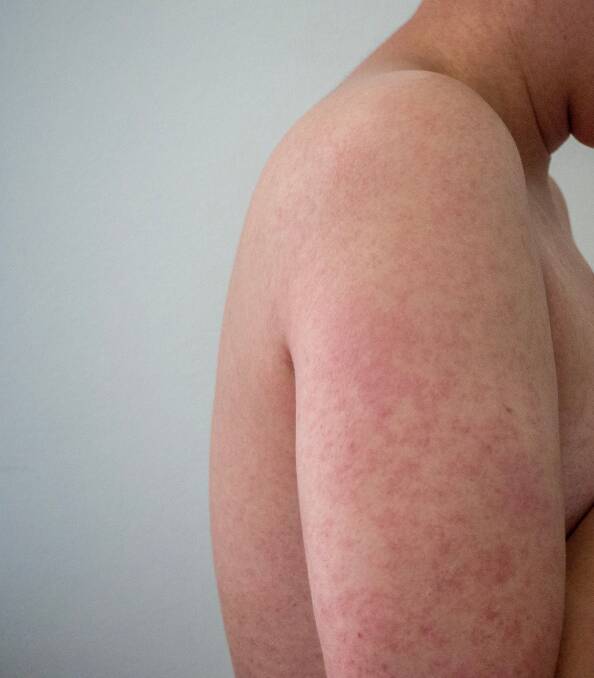 Telltale sign: A red rash like the one seen here is one of the symptoms of measles.
