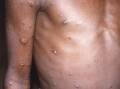 Health authorities have begun contact tracing after a man tested positive for monkeypox in Victoria.